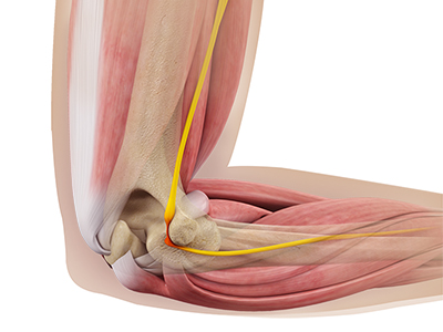 Ulnar Nerve Release - Educational Photo