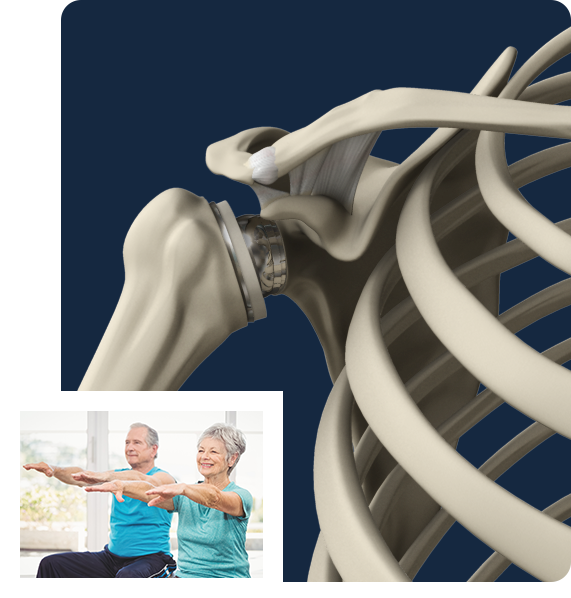 Reverse Shoulder Replacement