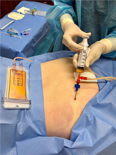 MFAT treatment image