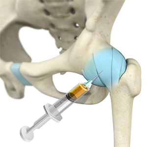 Peri-Articular Injections