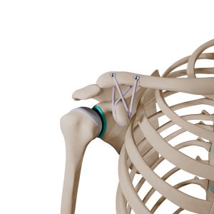 AC Joint Stabilization
