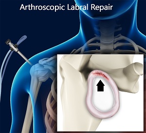 Labral Repair