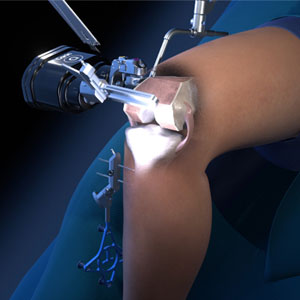 Robotic Assisted Knee Replacement pic