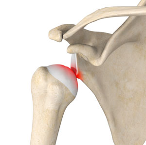 Shoulder Stabilisation