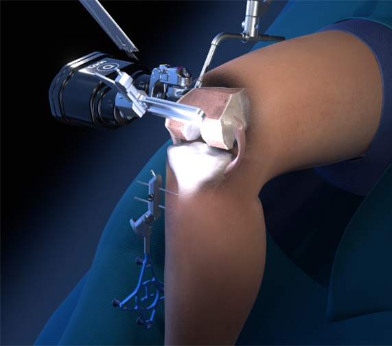 Robotic Knee & Shoulder Replacement
