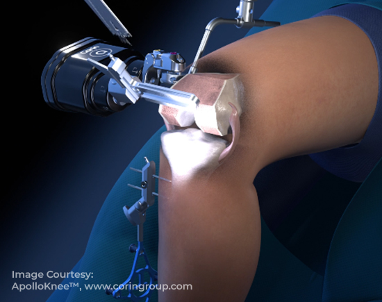Robotic Knee & Shoulder Replacement