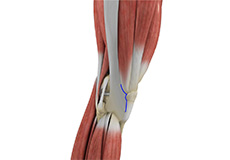 Subvastus Muscle Sparing Total Knee Replacement