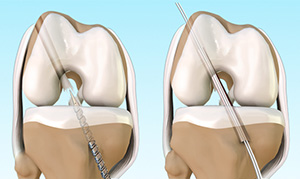 ACL Reconstruction images
