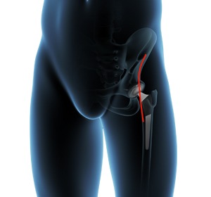Direct Anterior Hip Replacement