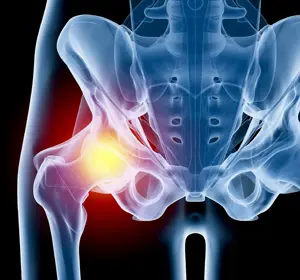 Hip Injury