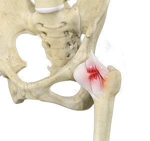 Hip Ligament Injuries