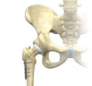 Hip Surgery
