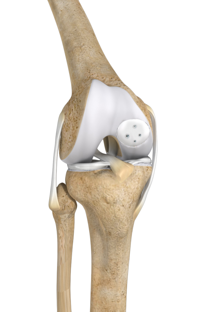 Knee Cartilage Restoration