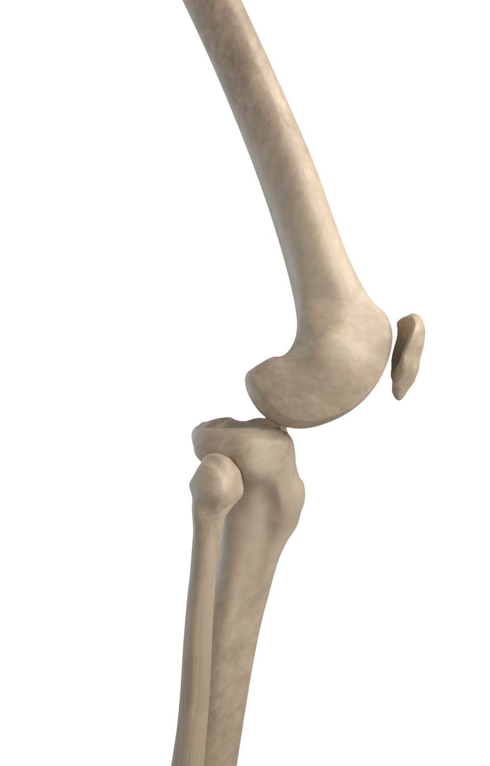 Knee Dislocation
