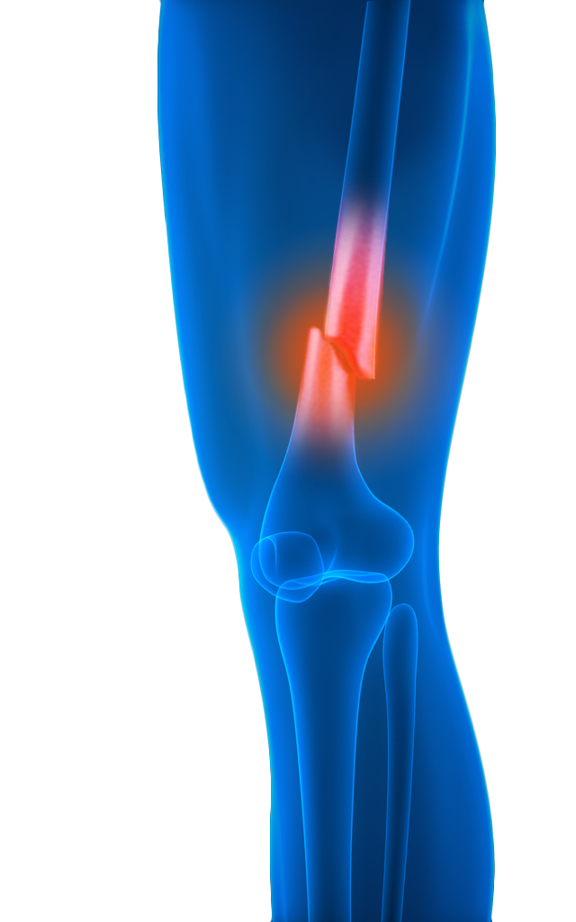 Knee Fracture
