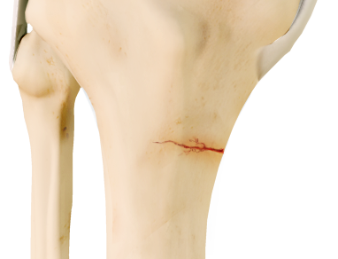Knee Stress Fractures