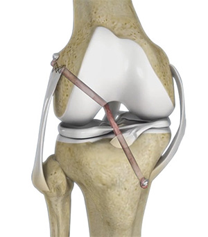 Multiligament Reconstruction of the Knee images