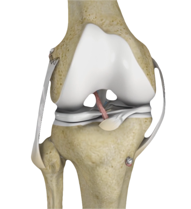 Multiligament Reconstruction of the Knee