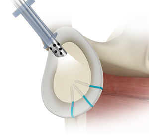 Shoulder Reconstruction Surgery images