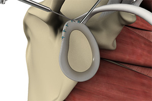 SLAP Repair images