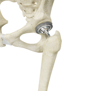 Total Hip Replacement images