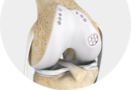 Cartilage Restoration Images