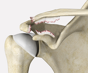 AC Joint Separation - Educational Picture