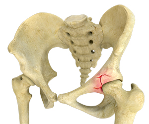 Acetabular Fracture - Educational Picture