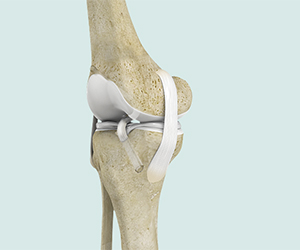 ACL Reconstruction - Educational Picture