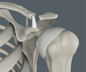 Acromioclavicular (AC) Joint Reconstruction - Educational Picture