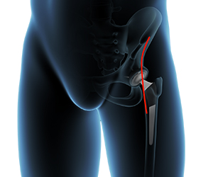 Anterior Hip Replacement - Educational Picture