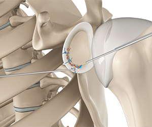 Arthroscopic Bankart Repair - Educational Picture