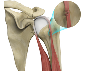 Bicep Tendon Rupture at Shoulder - Educational Picture