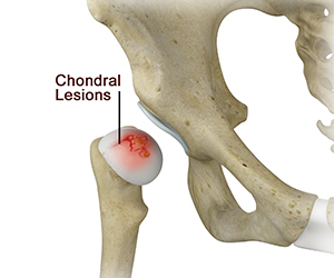 Chondral Lesions or Injuries of the Hip - Educational Picture