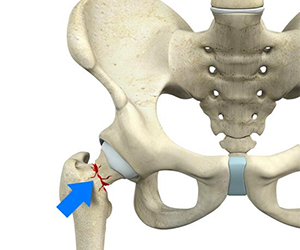 Femoral Neck Fracture - Educational Picture