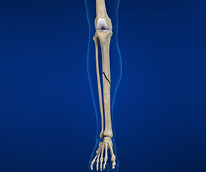 Fractures of the Tibia - Educational Picture