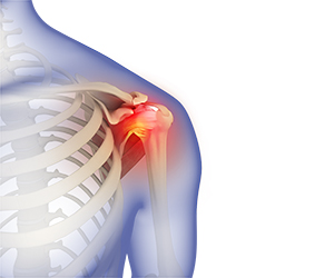 Frozen Shoulder - Educational Picture