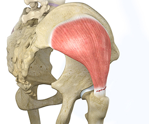 Hip Abductor Tears - Educational Picture