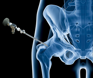 Hip Arthroscopy - Educational Picture