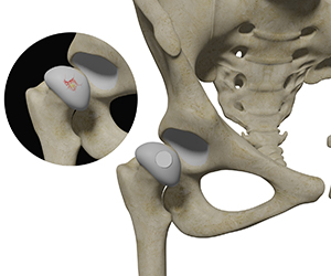 Hip Cartilage Restoration - Educational Picture