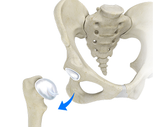 Hip Dislocation - Educational Picture