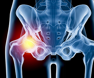 Hip Injury - Educational Picture