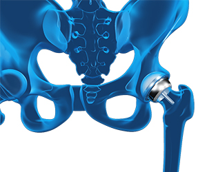 Hip Resurfacing - Educational Picture