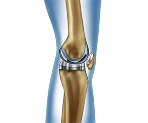 Jiffy Knee Joint Replacement - Educational Picture
