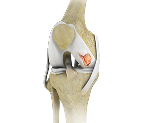Knee Cartilage Restoration - Educational Picture