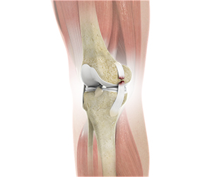Knee Ligament Injuries - Educational Picture