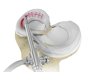 Meniscal Surgery - Educational Picture
