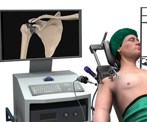 Minimally Invasive Shoulder Joint Replacement - Educational Picture