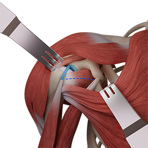 Muscle Sparing Shoulder Replacement - Educational Picture