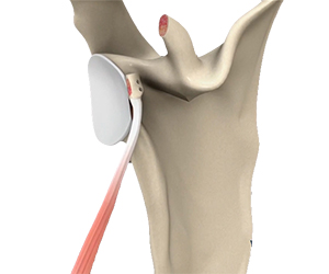 Open Shoulder Stabilization - Educational Picture